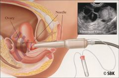 Illustration of steps involved in IVF egg retrieval