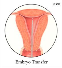 illustration of embryo transfer