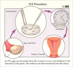 Illustration of steps in IVF