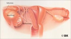 Illustration of Adhesiolysis